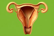 علاج تليف الرحم