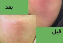 البشرة الوردية