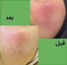 البشرة الوردية