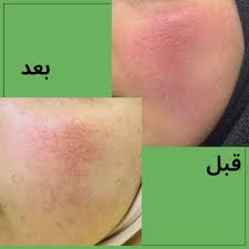 البشرة الوردية